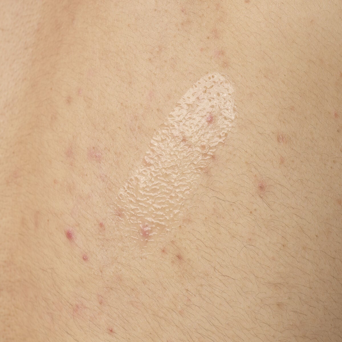 salicylic-acid-0-5-body-serum-p4 ORD-salicylic-acid-05-body-240ml-application.jpg