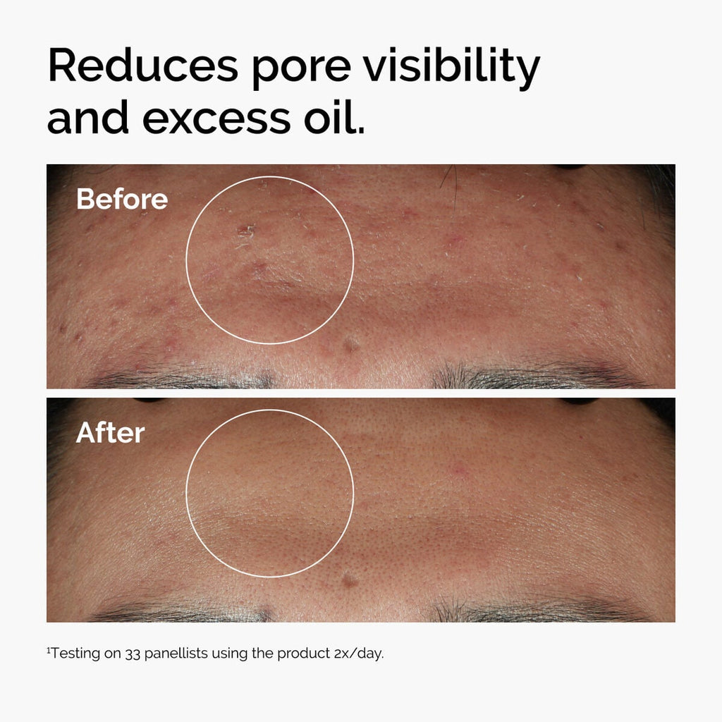niacinamide-10-zinc-1-s0 ord-niacinamide-zinc-blemish-serum-before-after-pores.jpg