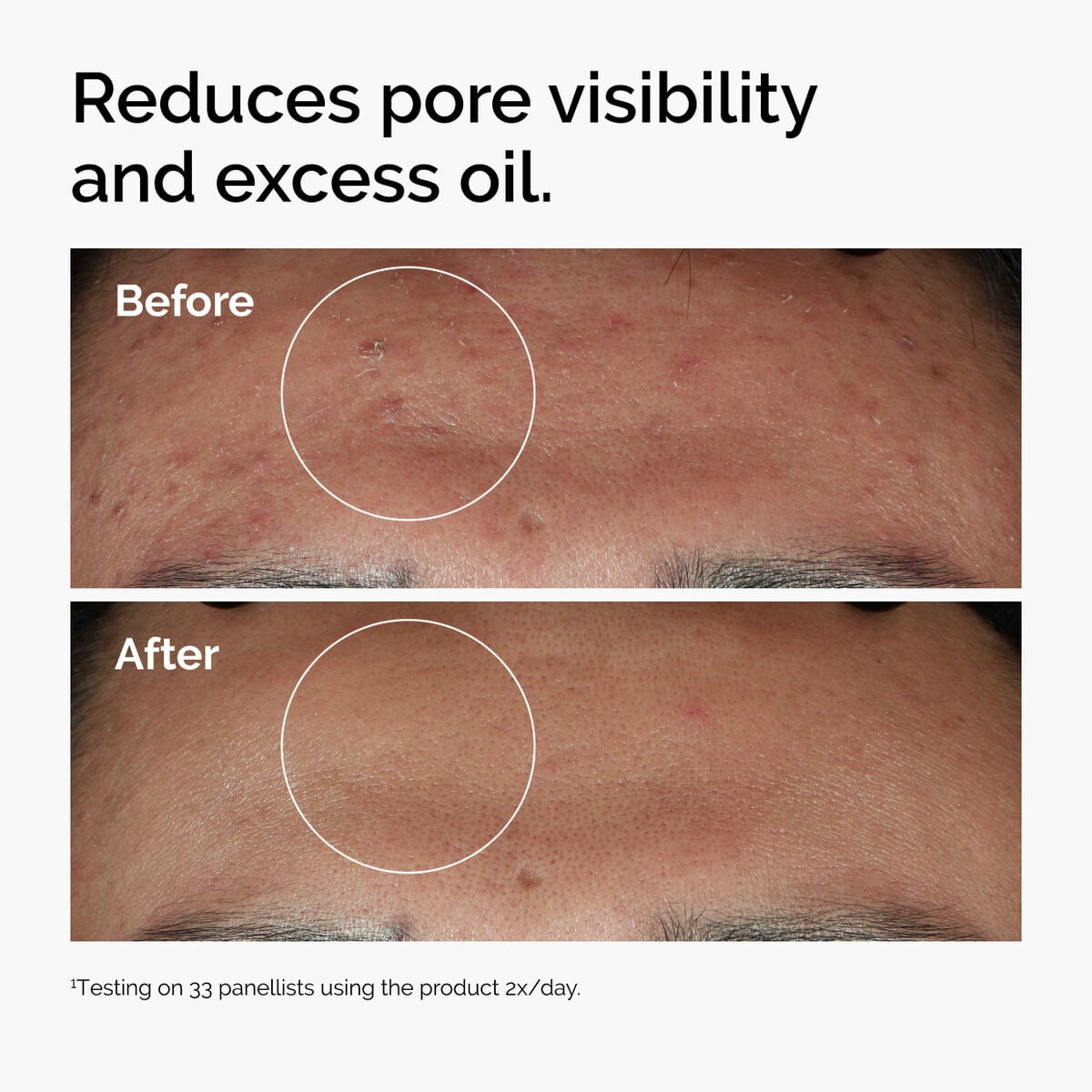 niacinamide-10-zinc-1-s0 ord-niacinamide-zinc-blemish-serum-before-after-pores.jpg