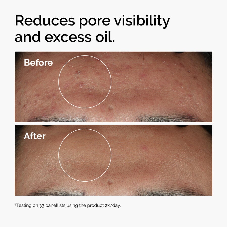 niacinamide-10-zinc-1-s0 ord-niacinamide-zinc-blemish-serum-before-after-pores.jpg