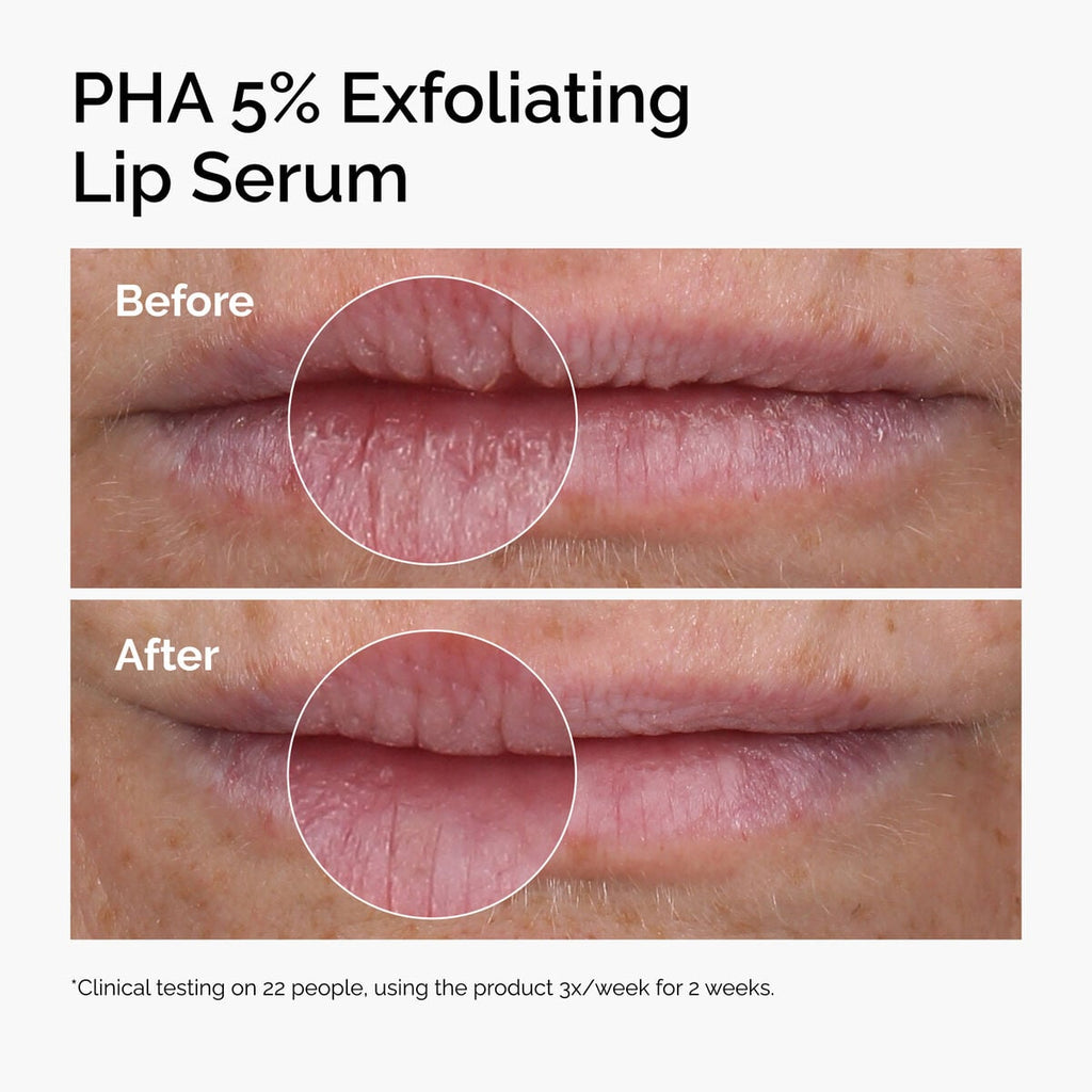 pha-5-exfoliating-lip-serum-t7 ord-pha-5pct-lip-exfoliating-serum-before-after.jpg