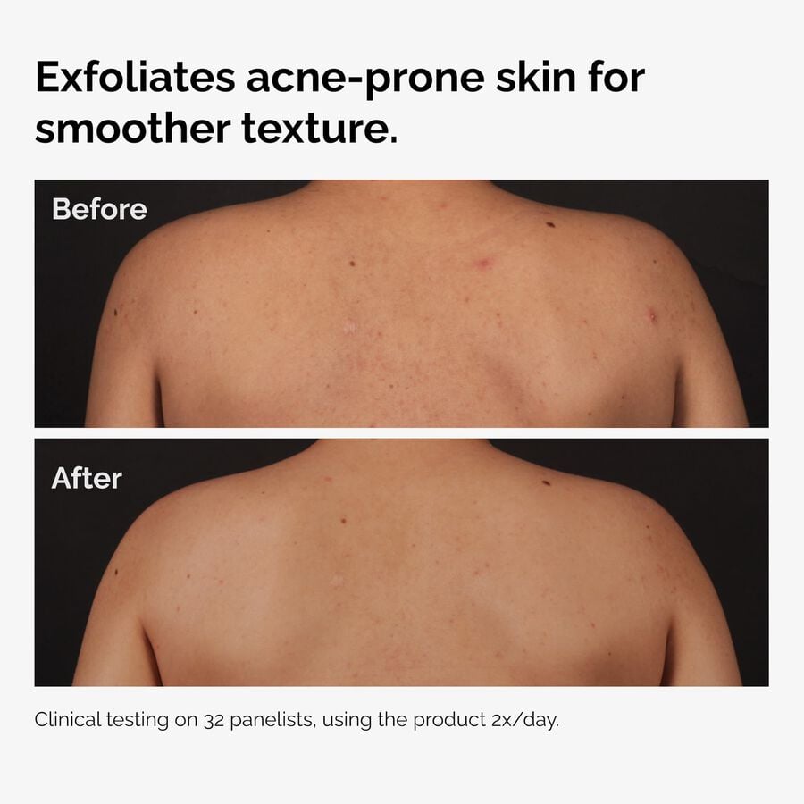 salicylic-acid-0-5-body-serum-p4 ord-salicylic-acid-body-serum-before-after-graphic-NA.jpg