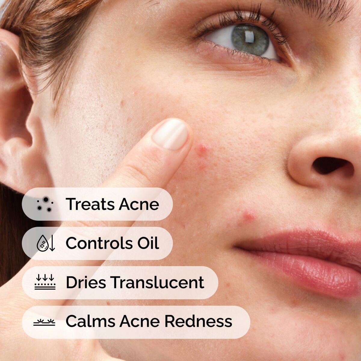 sulfur-10-powder-to-cream-concentrate-g0 ord-sulfur-10pct-powder-to-cream-concentrate-model-application-with-benefits-acne.jpg