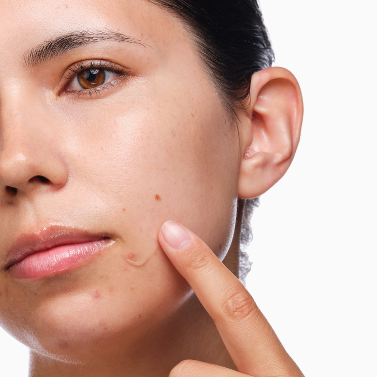 the-acne-set-f1 rdn-the-acne-set-application.png